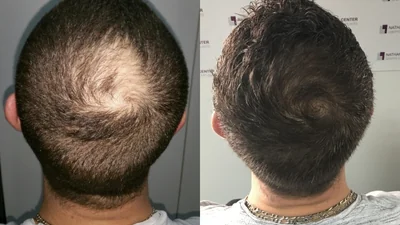 Greffe de cheveux — vertex et tonsure : avant à gauche, après à droite, à 12 mois ; tonsure