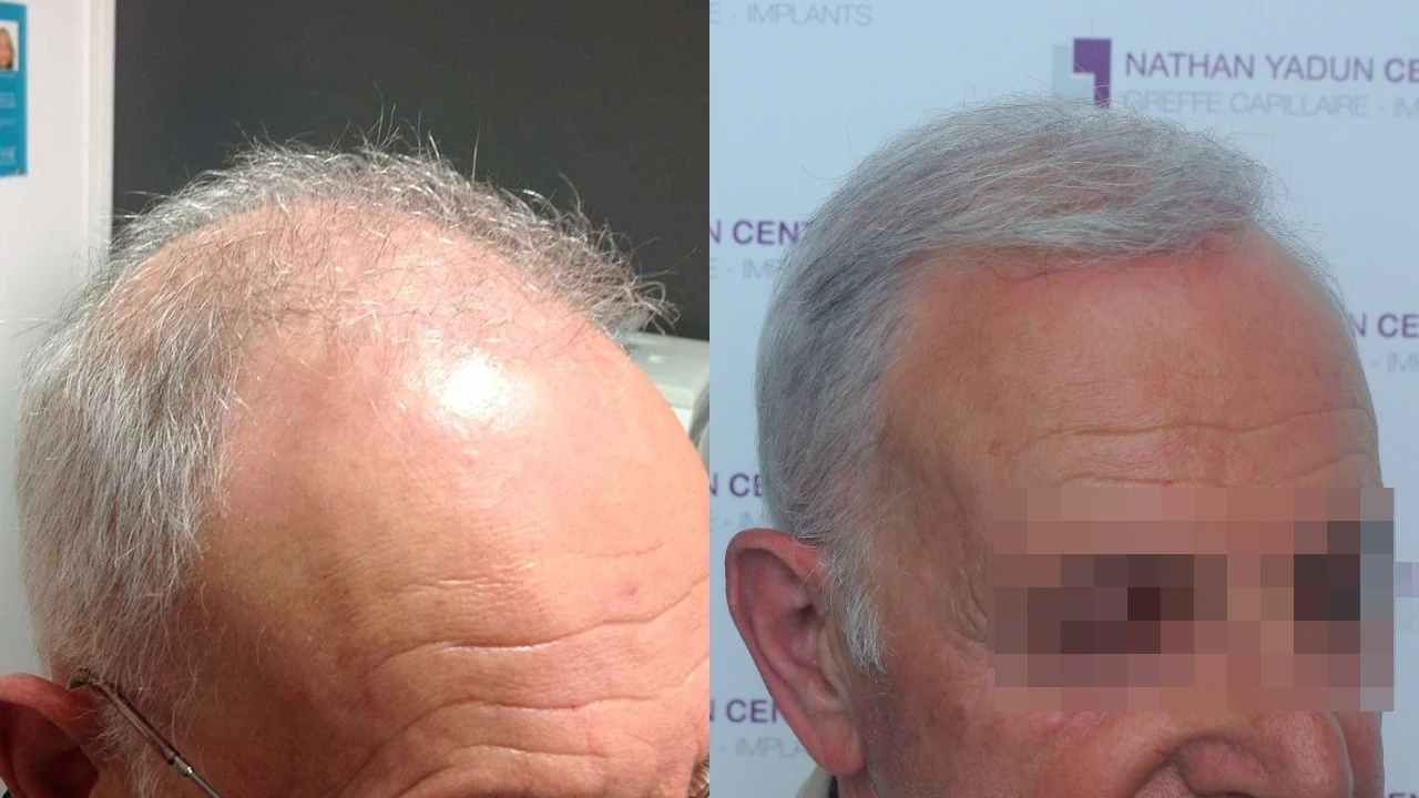Greffe de cheveux — zone frontale, mid-scalp et vertex : avant à gauche, après à droite, à 12 mois ; vue oblique