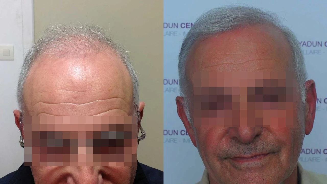 Greffe de cheveux — zone frontale, mid-scalp et vertex : avant à gauche, après à droite, à 12 mois ; face