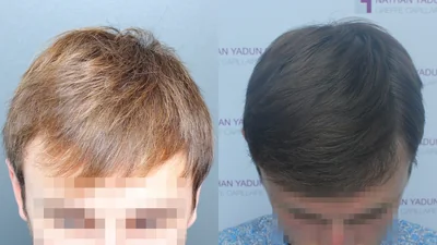 Greffe de cheveux — densification de la zone frontale : avant à gauche, après à droite, à 8 mois ; vue du dessus