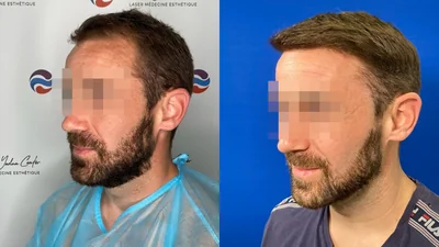 Greffe de cheveux — ligne frontale et golfes temporaux : avant à gauche, après à droite, à 10 mois ; vue oblique