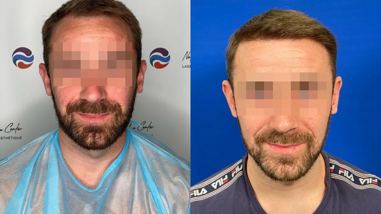 Greffe de cheveux — ligne frontale et golfes temporaux : avant à gauche, après à droite, à 10 mois ; face