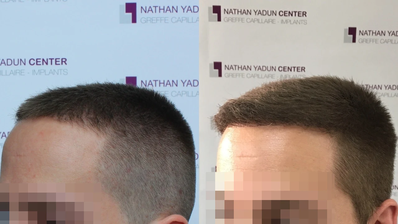 Greffe de cheveux — abaissement de la ligne frontale : avant à gauche, après à droite, à 9 mois ; vue latérale