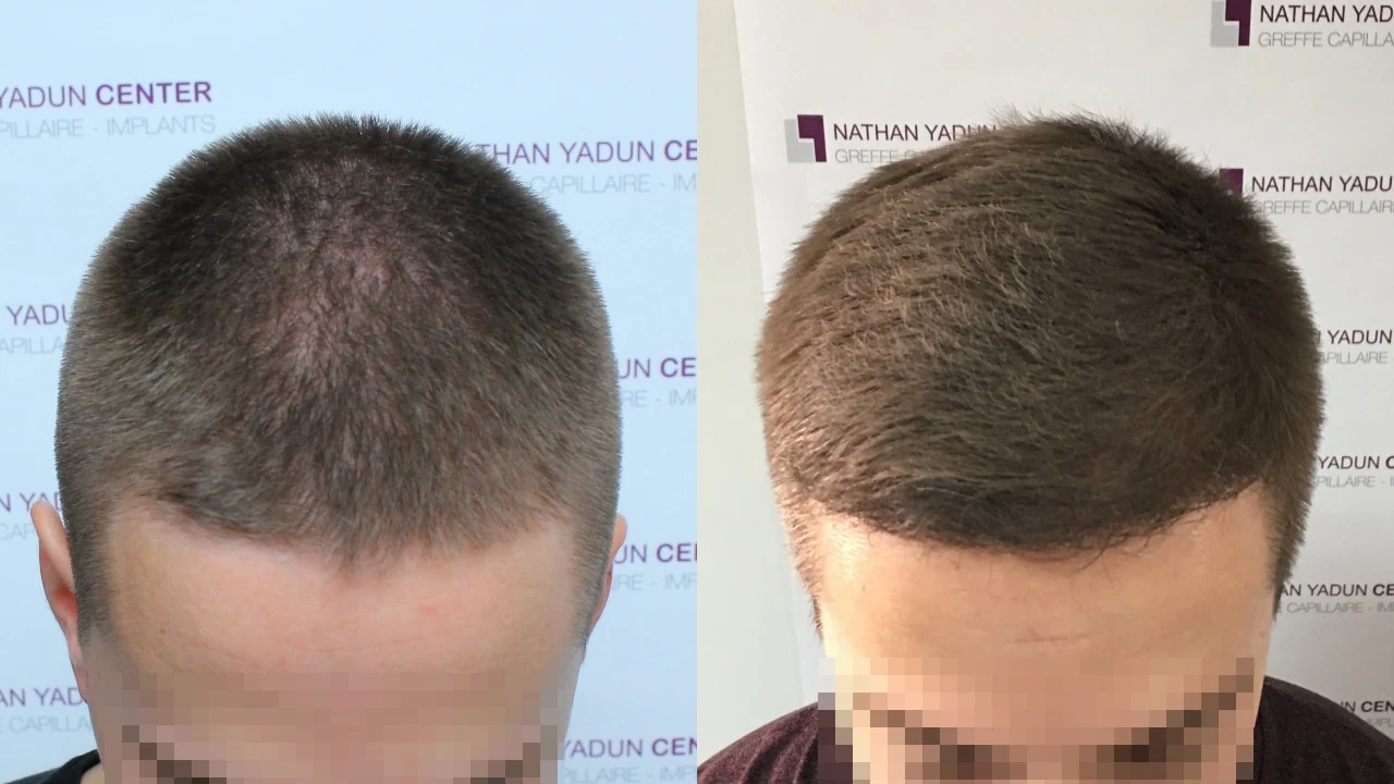 Greffe de cheveux — abaissement de la ligne frontale : avant à gauche, après à droite, à 9 mois ; vue du dessus
