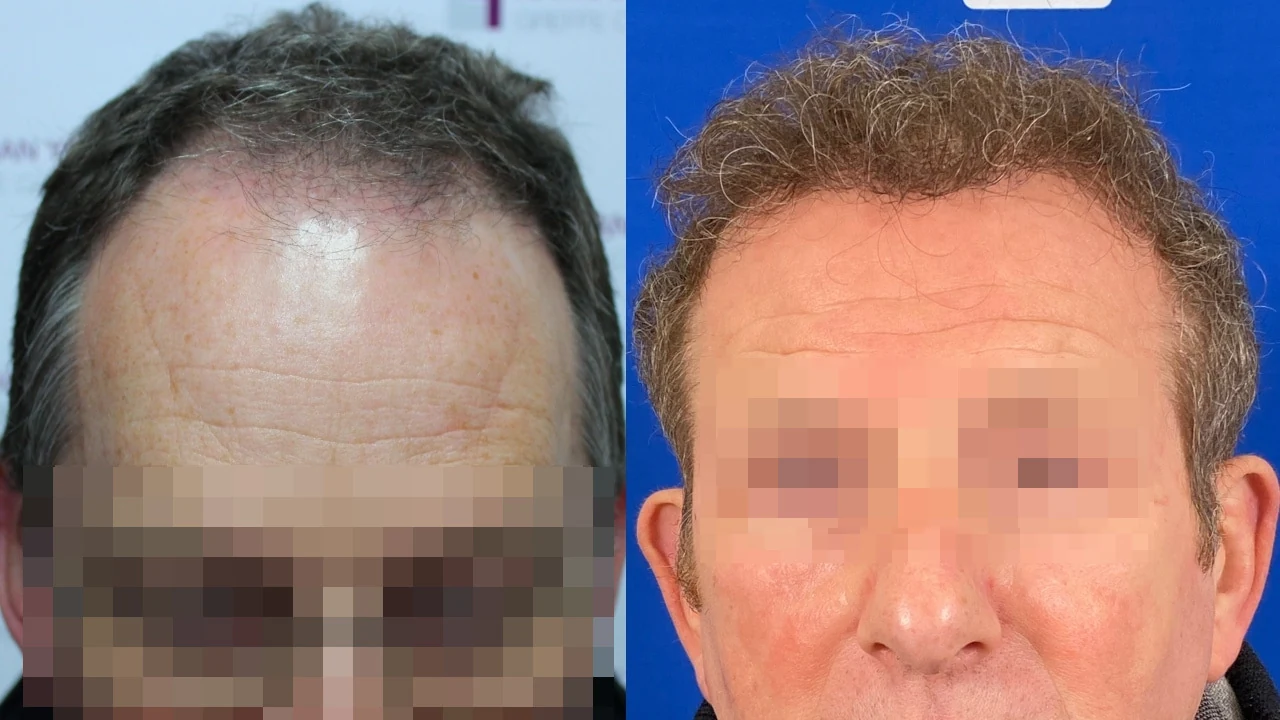 Greffe de cheveux — densification de la zone frontale : avant à gauche, après à droite, à 12 mois ; face