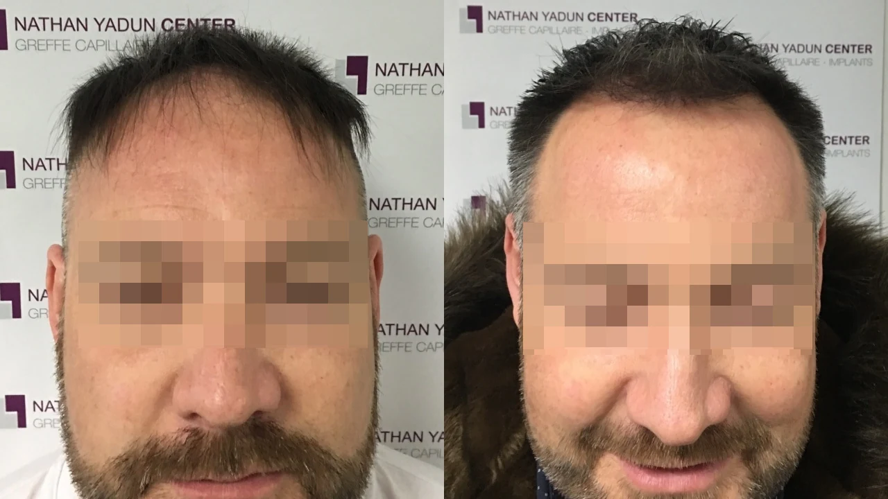 Greffe de cheveux — zone frontale et mid-scalp : avant à gauche, après à droite, à 7 mois ; face