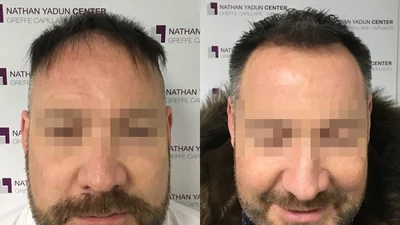 Greffe de cheveux — zone frontale et mid-scalp : avant à gauche, après à droite, à 7 mois ; face