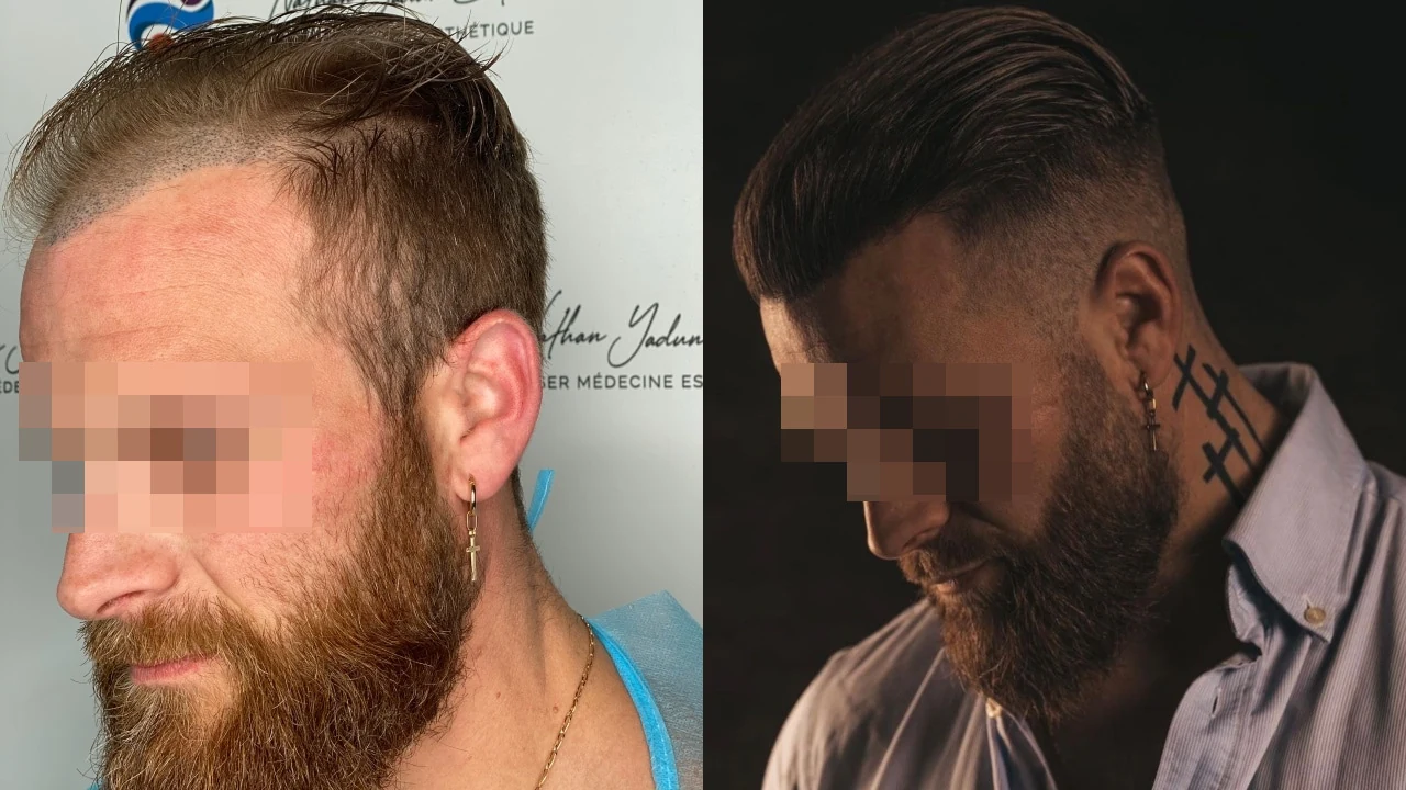 Greffe de cheveux — ligne frontale et golfes temporaux : avant à gauche, après à droite, à 10 mois ; vue oblique