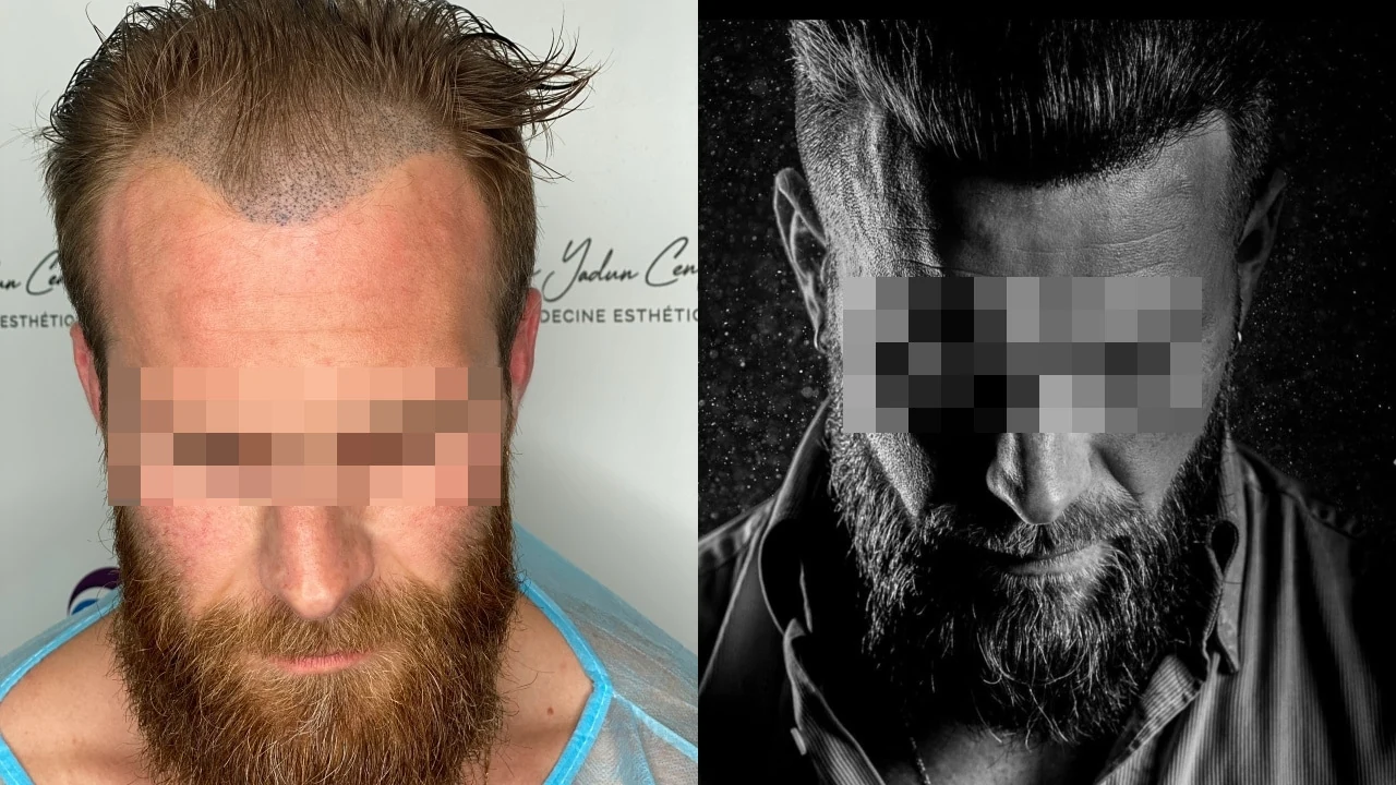 Greffe de cheveux — ligne frontale et golfes temporaux : avant à gauche, après à droite, à 10 mois ; face