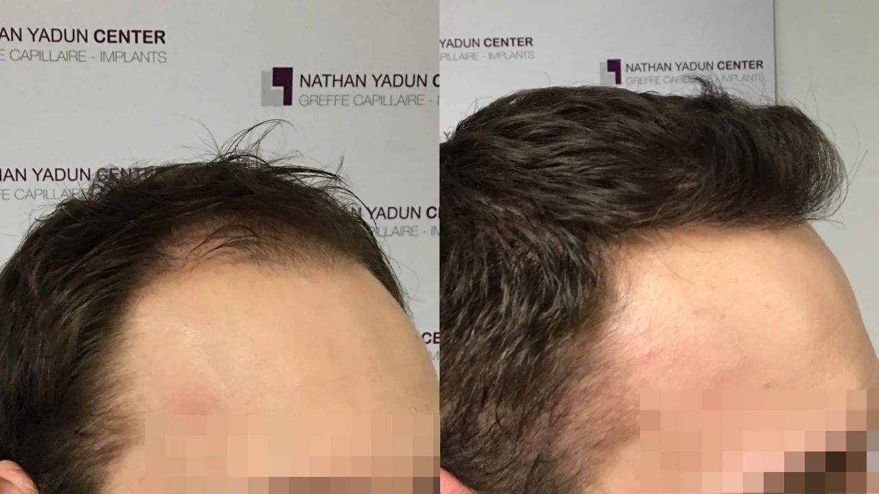 Greffe de cheveux — région fronto-temporale et mid-scalp : avant à gauche, après à droite, à 11 mois ; vue oblique