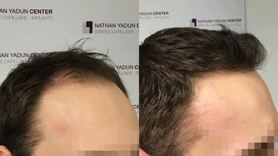 Greffe de cheveux — région fronto-temporale et mid-scalp : avant à gauche, après à droite, à 11 mois ; vue oblique