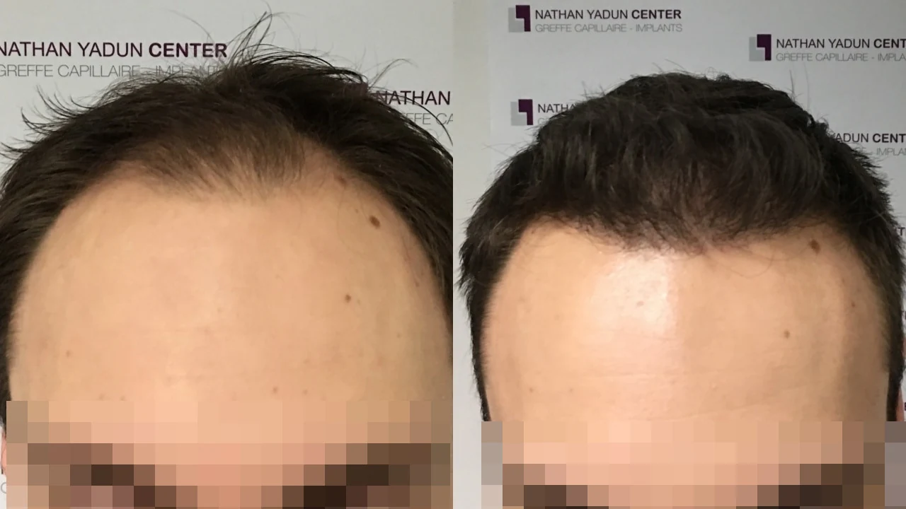 Greffe de cheveux — région fronto-temporale et mid-scalp : avant à gauche, après à droite, à 11 mois ; face