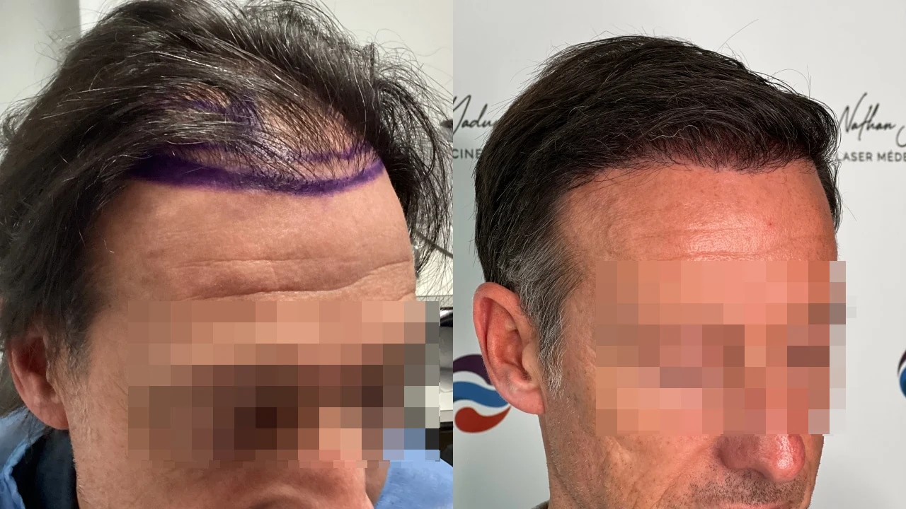 Greffe de cheveux — zone frontale et mid-scalp : avant à gauche, après à droite, à 9 mois ; vue oblique