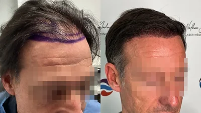 Greffe de cheveux — zone frontale et mid-scalp : avant à gauche, après à droite, à 9 mois ; vue oblique