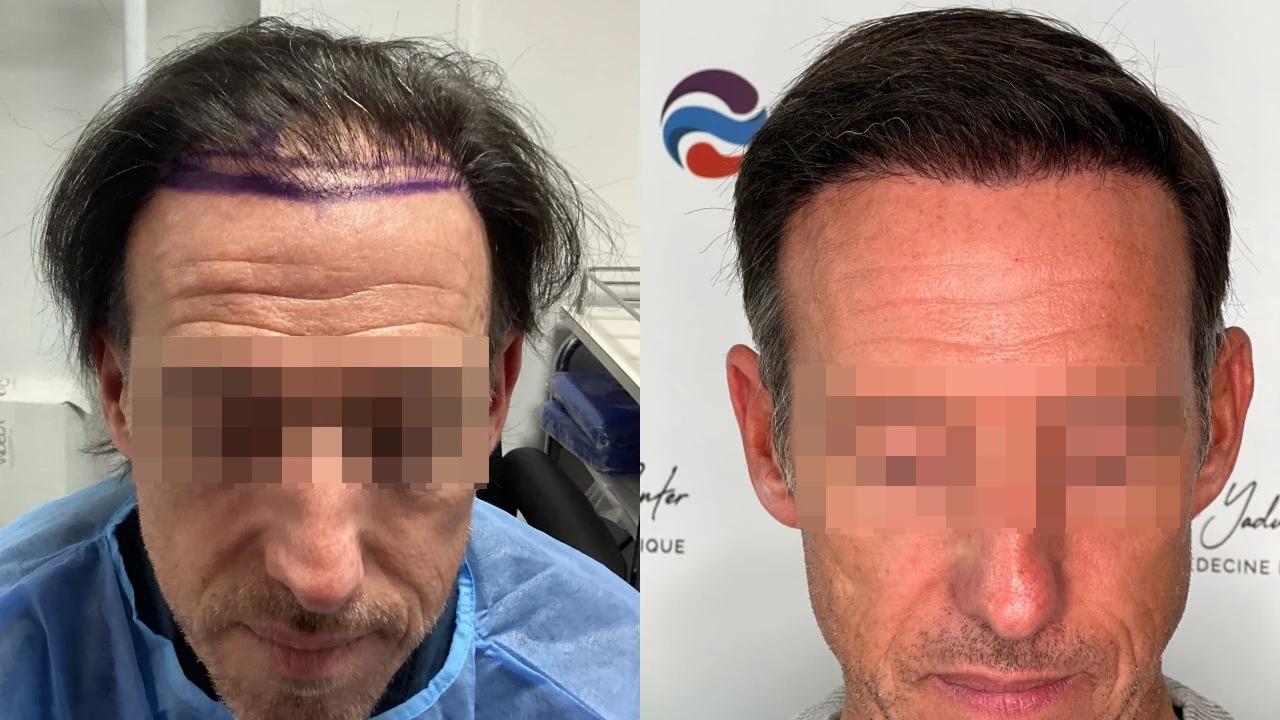 Greffe de cheveux — zone frontale et mid-scalp : avant à gauche, après à droite, à 9 mois ; face