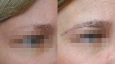 Greffe de sourcils — corps et queue des sourcils : avant à gauche, après à droite, à 9 mois ; sourcil droit