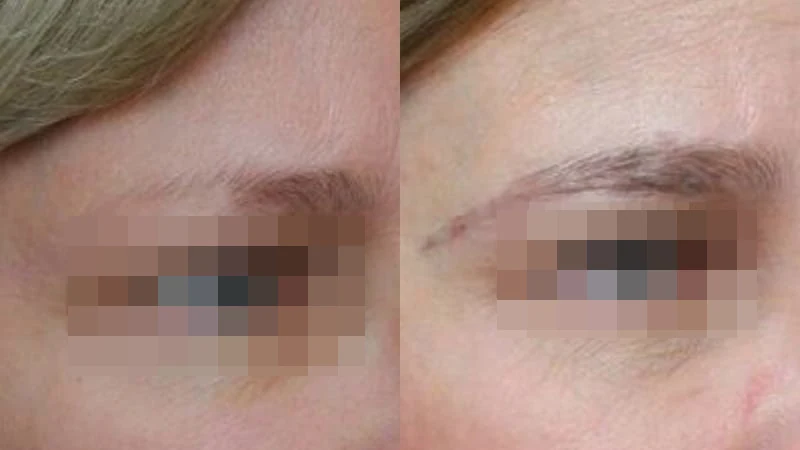 Greffe de sourcils — corps et queue des sourcils : avant à gauche, après à droite, à 9 mois ; sourcil droit