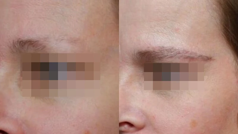 Greffe de sourcils — corps et queue des sourcils : avant à gauche, après à droite, à 9 mois ; sourcil gauche