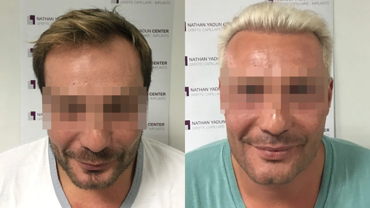 Greffe de cheveux — ligne frontale et golfes temporaux : avant à gauche, après à droite, à 12 mois ; face