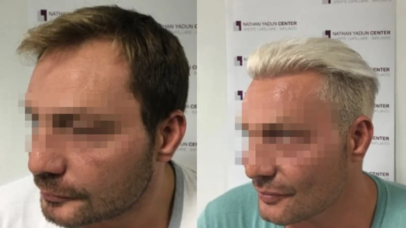Greffe de cheveux — ligne frontale et golfes temporaux : avant à gauche, après à droite, à 12 mois ; vue oblique