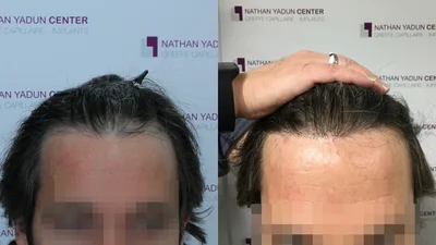 Greffe de cheveux — ligne frontale et golfes, sans rasage : avant à gauche, après à droite, à 9 mois ; face