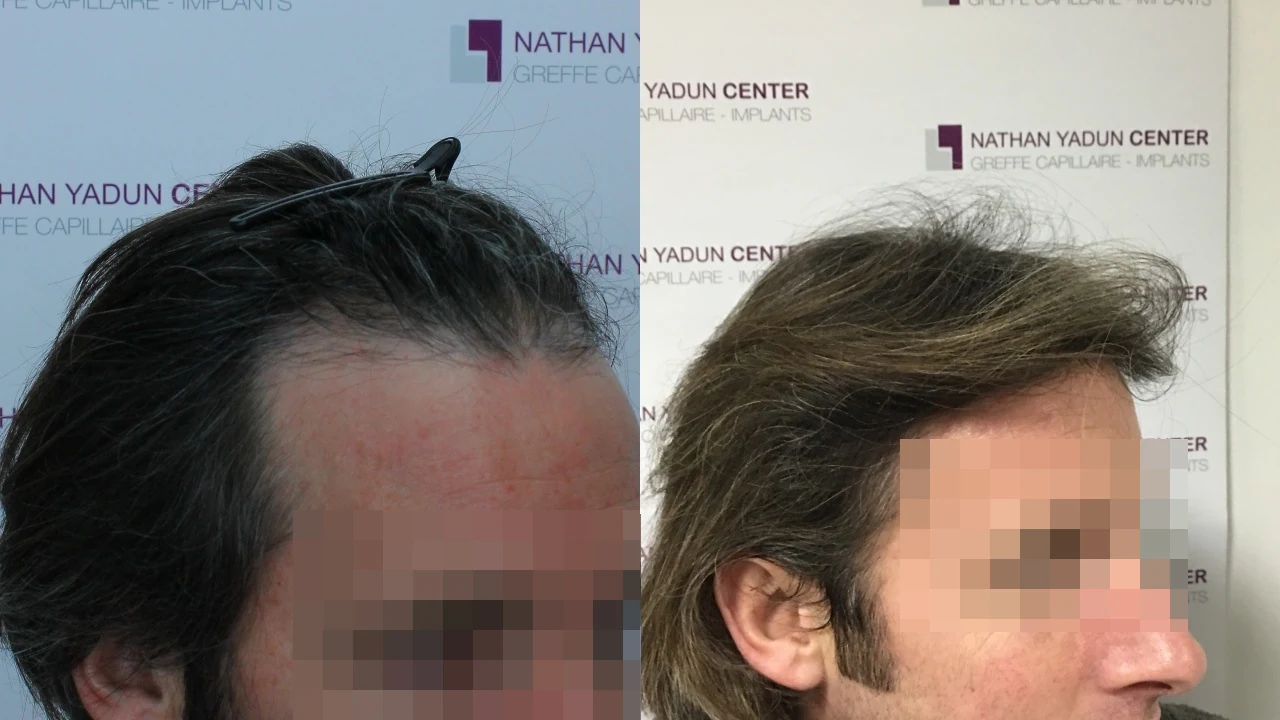 Greffe de cheveux — ligne frontale et golfes, sans rasage : avant à gauche, après à droite, à 9 mois ; vue latérale