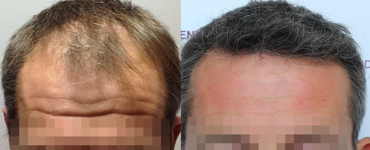 Greffe de cheveux — ligne frontale et golfes temporaux : avant à gauche, après à droite, à 13 mois ; face