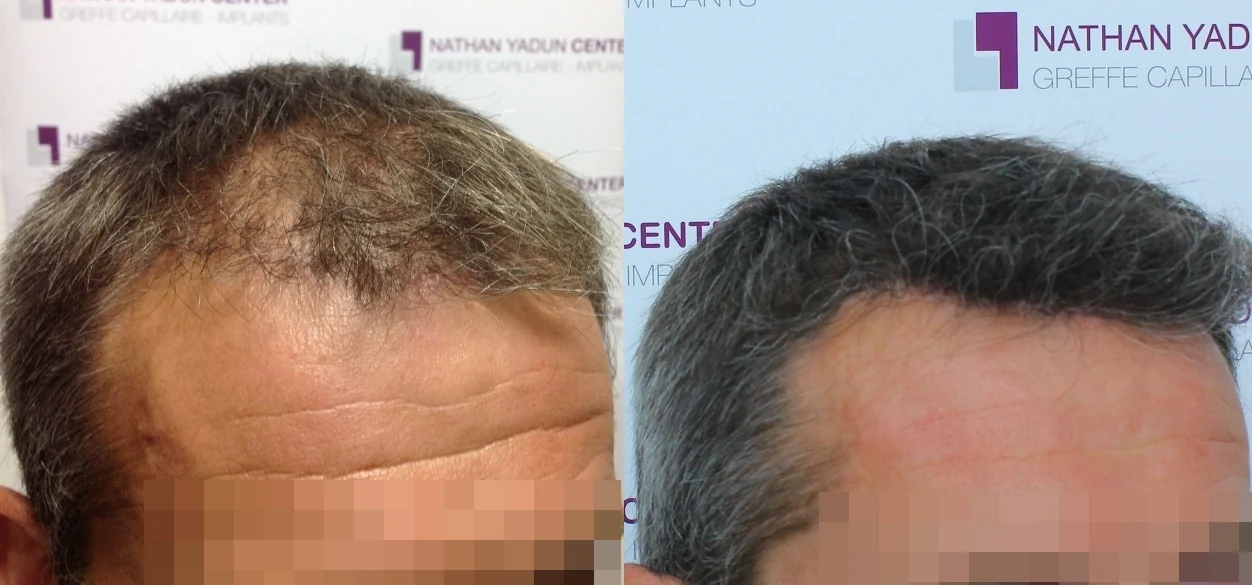 Greffe de cheveux — ligne frontale et golfes temporaux : avant à gauche, après à droite, à 13 mois ; vue oblique