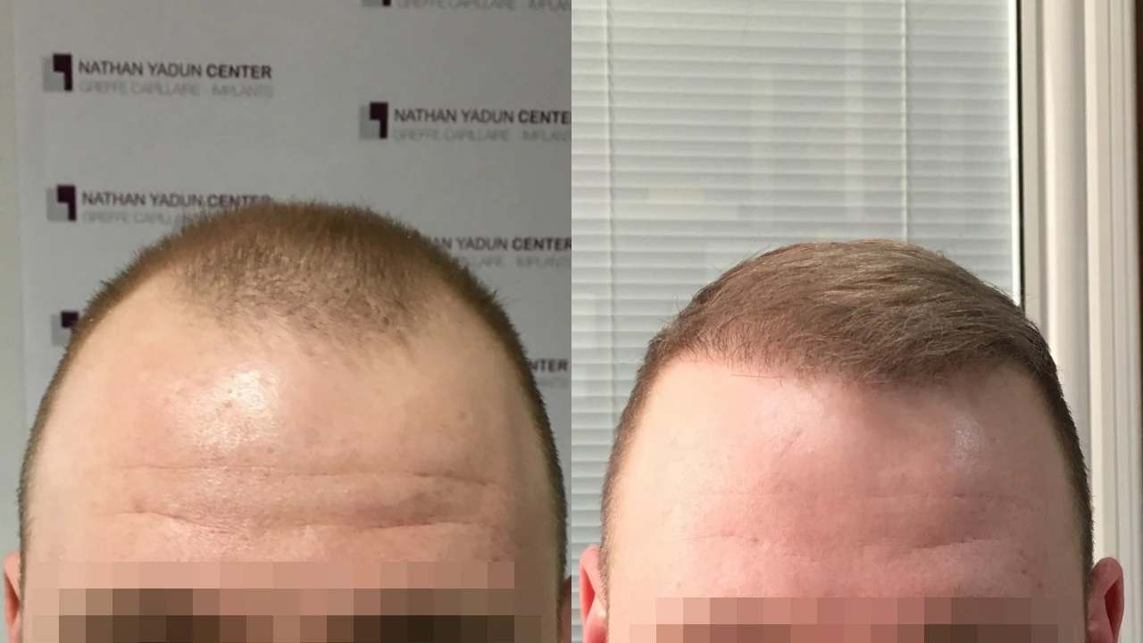 Greffe de cheveux — ligne frontale et golfes temporaux : avant à gauche, après à droite, à 10 mois ; zone frontale