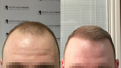 Greffe de cheveux — ligne frontale et golfes temporaux : avant à gauche, après à droite, à 10 mois ; zone frontale