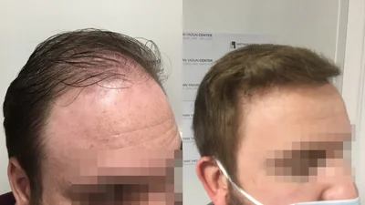 Greffe de cheveux — zone frontale, mid-scalp et vertex : avant à gauche, après à droite, à 8 mois ; vue oblique