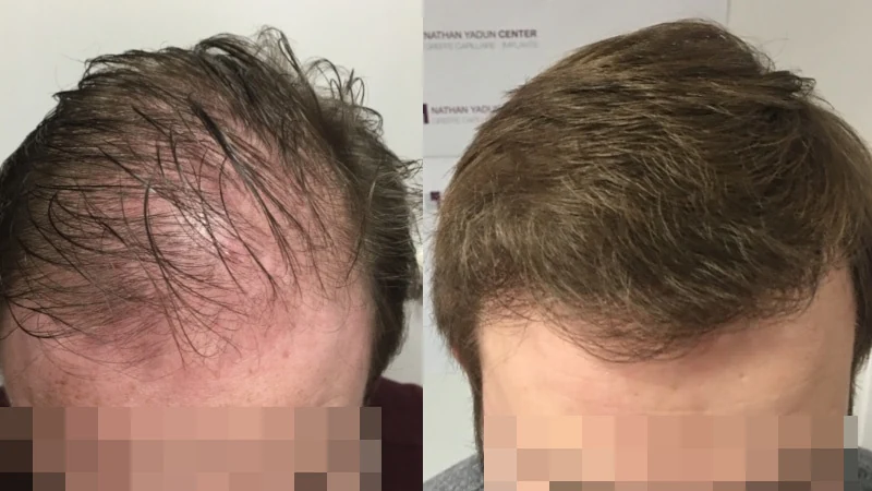 Greffe de cheveux — zone frontale, mid-scalp et vertex : avant à gauche, après à droite, à 8 mois ; vue du dessus
