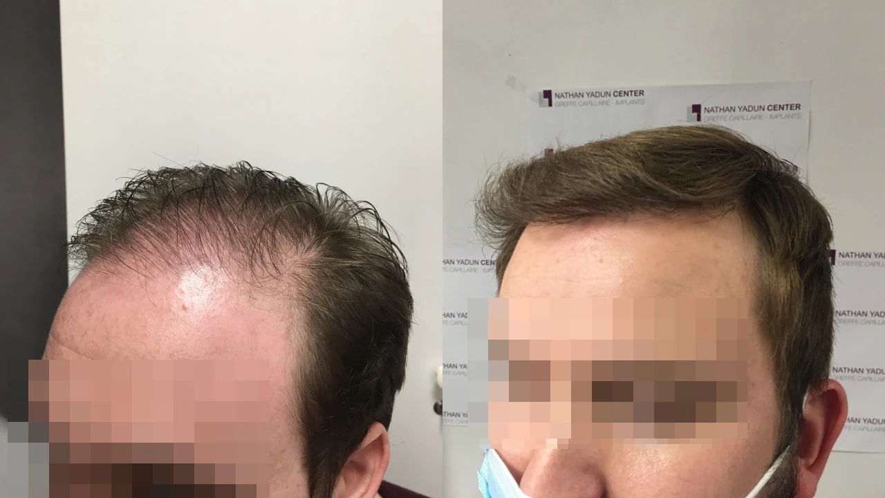 Greffe de cheveux — zone frontale, mid-scalp et vertex : avant à gauche, après à droite, à 8 mois ; zone frontale