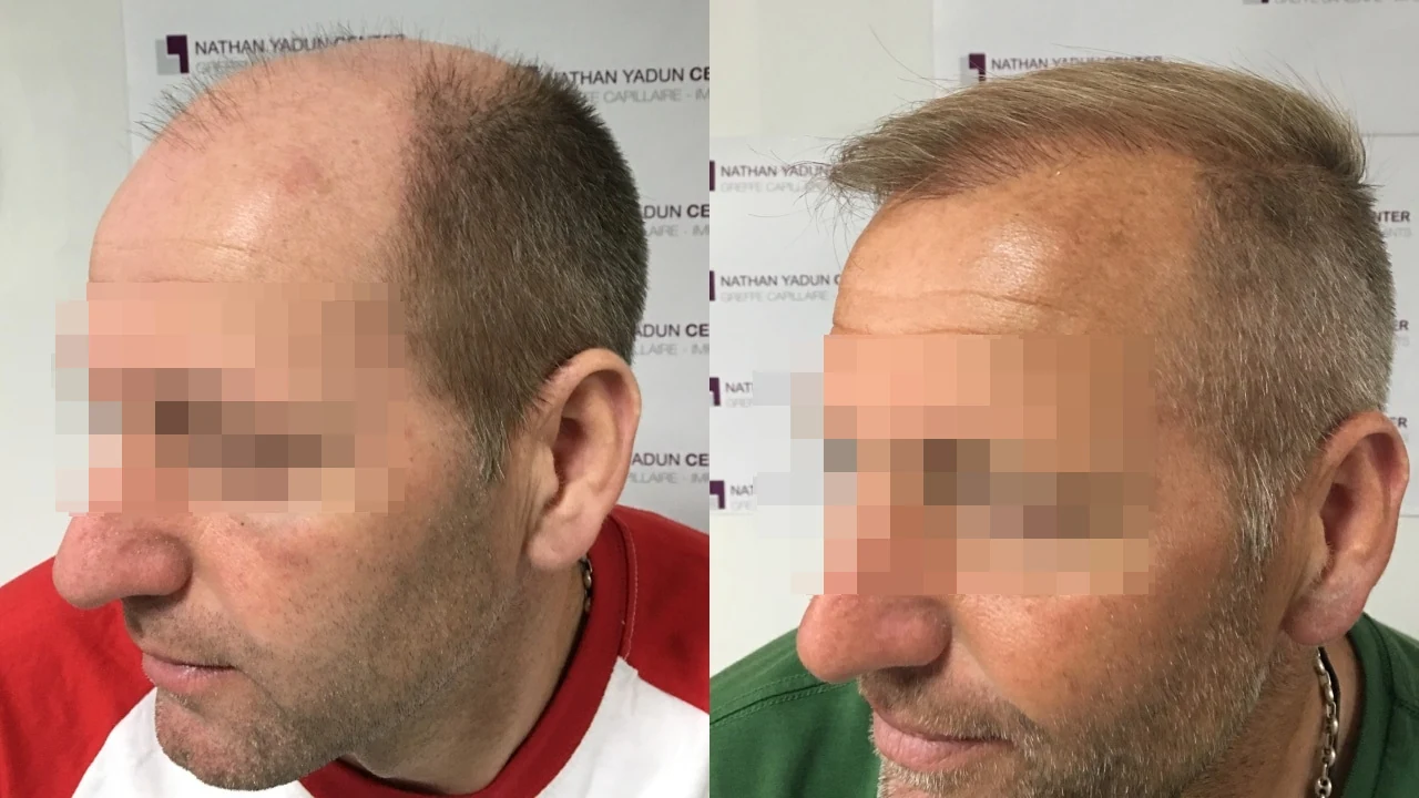 Greffe de cheveux — restauration en deux séances : avant à gauche, après à droite, à 7 mois après la deuxième séance ; vue latérale 1