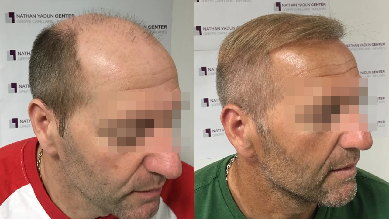 Greffe de cheveux — restauration en deux séances : avant à gauche, après à droite, à 7 mois après la deuxième séance ; vue latérale 2