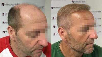 Greffe de cheveux — restauration en deux séances : avant à gauche, après à droite, à 7 mois après la deuxième séance ; vue latérale 2