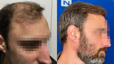 Greffe de cheveux — restauration en deux séances : avant à gauche, après à droite, à 8 mois après la deuxième séance ; angles de prise de vue différents