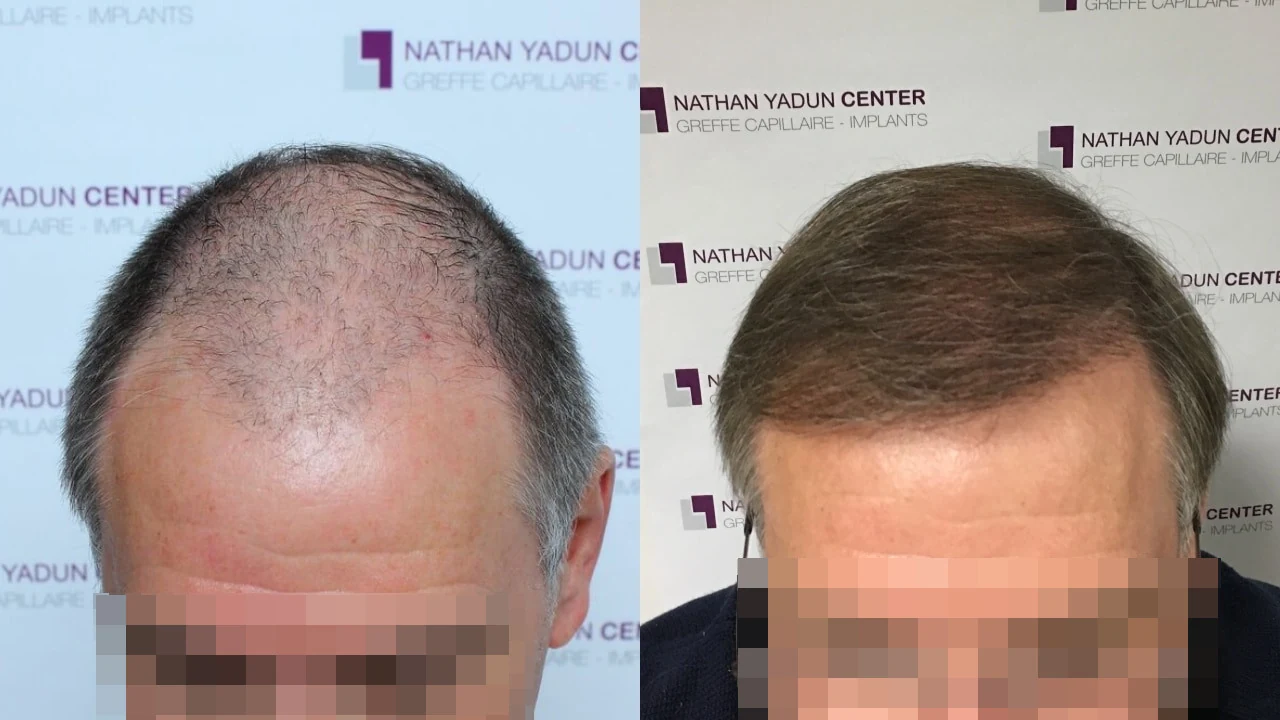 Greffe de cheveux — zone frontale et sommet du crâne : avant à gauche, après à droite, à 11 mois ; vue du dessus