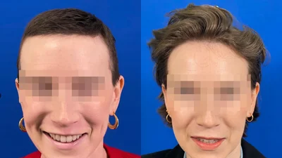 Greffe de cheveux — correction de la récession temporale : avant à gauche, après à droite, à 9 mois ; face