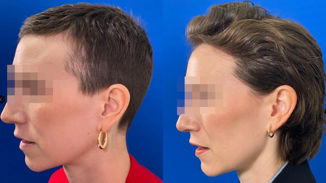 Greffe de cheveux — correction de la récession temporale : avant à gauche, après à droite, à 9 mois ; vue latérale 1