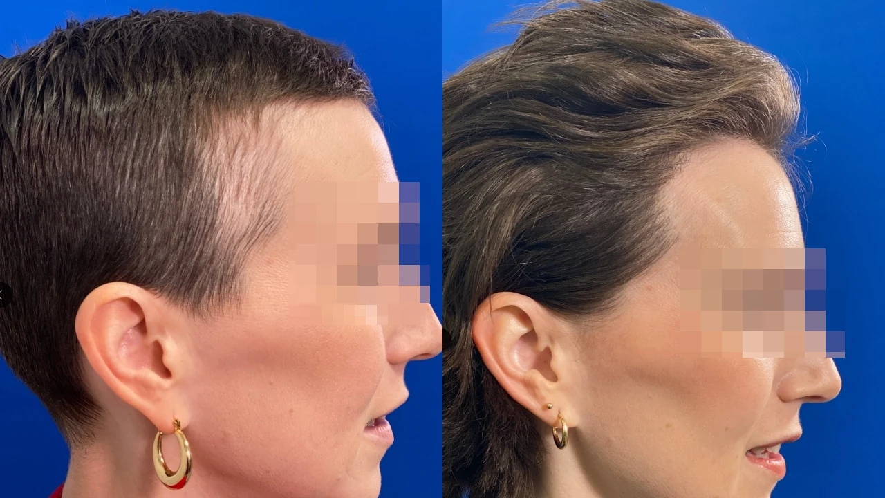 Greffe de cheveux — correction de la récession temporale : avant à gauche, après à droite, à 9 mois ; vue latérale 2