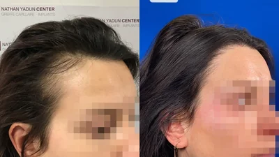 Greffe de cheveux — correction de la récession temporale : avant à gauche, après à droite, à 14 mois ; région temporale