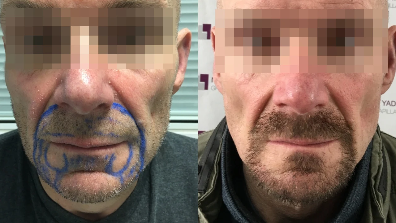 Greffe de barbe — densification du bouc : avant à gauche, après à droite, à 8 mois ; bouc