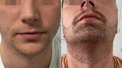 Greffe de barbe — joues, pattes, menton et cou : avant à gauche, après à droite, à 6 mois après la deuxième séance ; face et menton