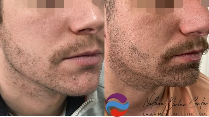 Greffe de barbe — joues, pattes, menton et cou : avant à gauche, après à droite, à 6 mois après la deuxième séance ; vue oblique