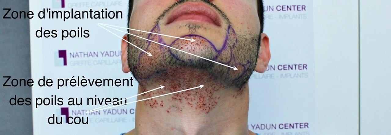 Schéma photographique des zones de prélèvement au cou et d’implantation dans la barbe