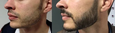 Greffe de barbe — densification des joues et du menton : avant à gauche, après à droite, à 5 mois ; vue latérale