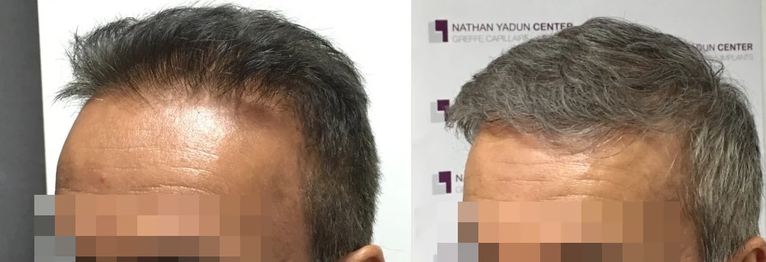 Greffe de cheveux — zone frontale et mid-scalp : avant à gauche, après à droite, à 12 mois ; zone frontale