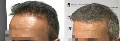 Greffe de cheveux — zone frontale et mid-scalp : avant à gauche, après à droite, à 12 mois ; zone frontale