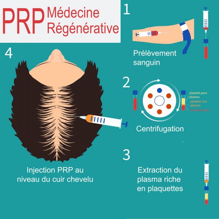 PRP Médecine régénérative